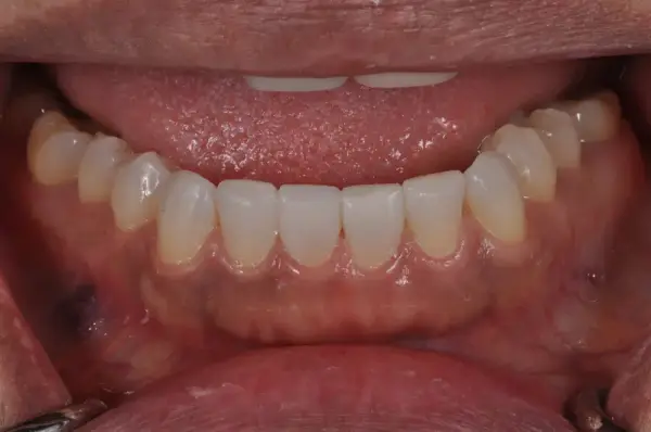 After — Lower Arch Porcelain Veneers