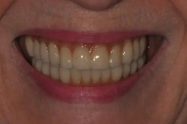 After — Custom Complete Denture Smile Restoration