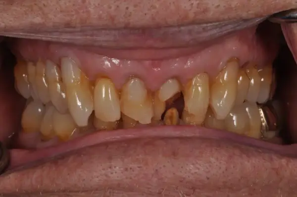 Before — Maxillary Full Arch Restoration