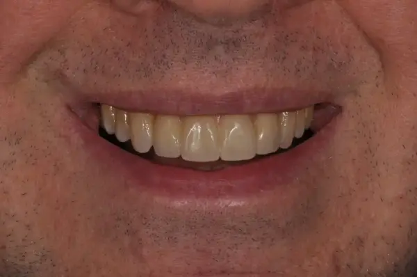 After — Porcelain Veneer Smile Makeover
