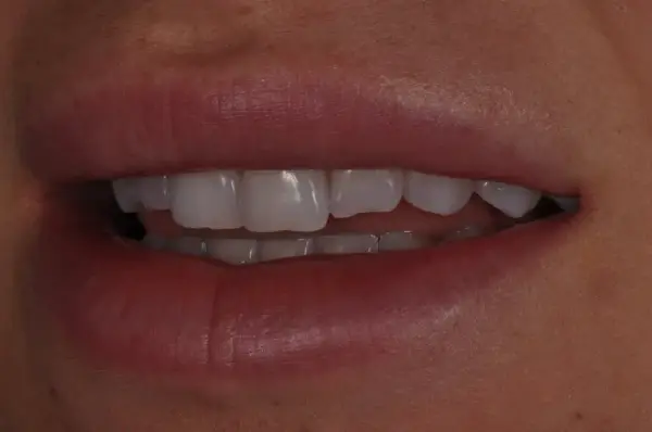 Before — Porcelain Veneer for Chipped Front Tooth