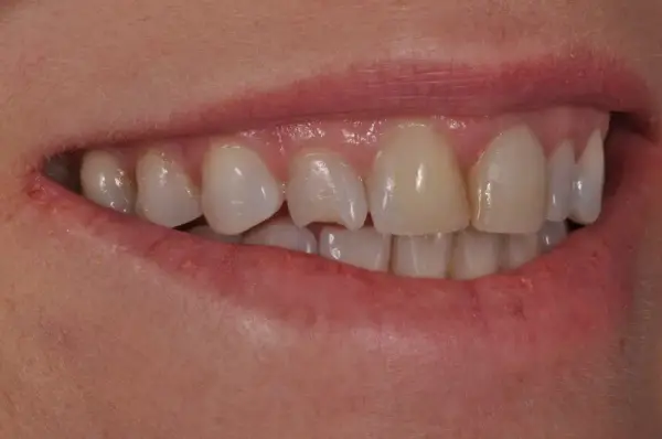 Before — Anterior Cosmetic Smile Treatment