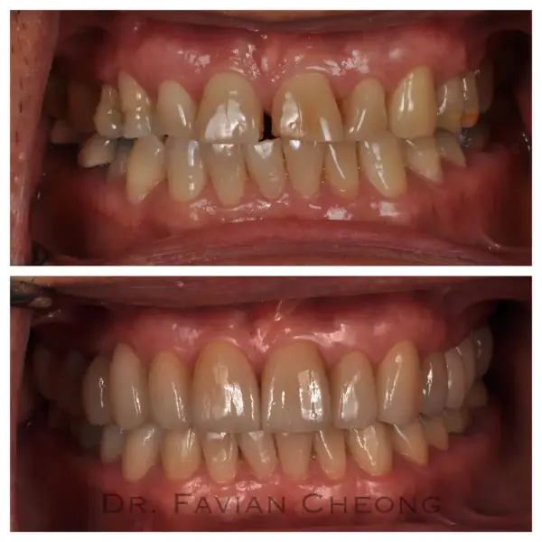 Result — Anterior Porcelain Veneers