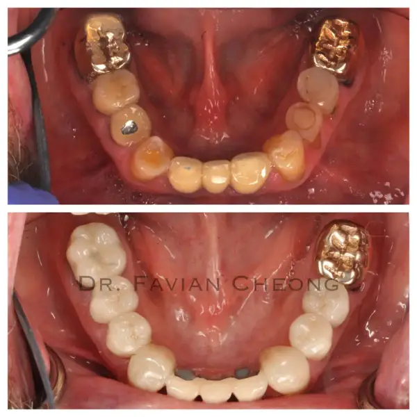 Result — Mandibular Full Arch Restoration
